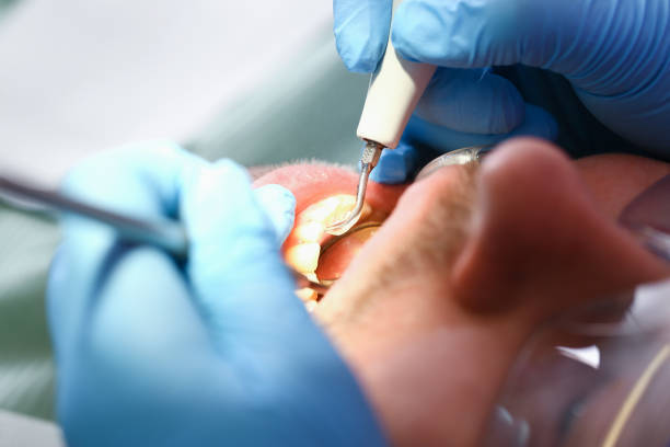 Best Emergency Dental Extractions in Port Aransas, TX