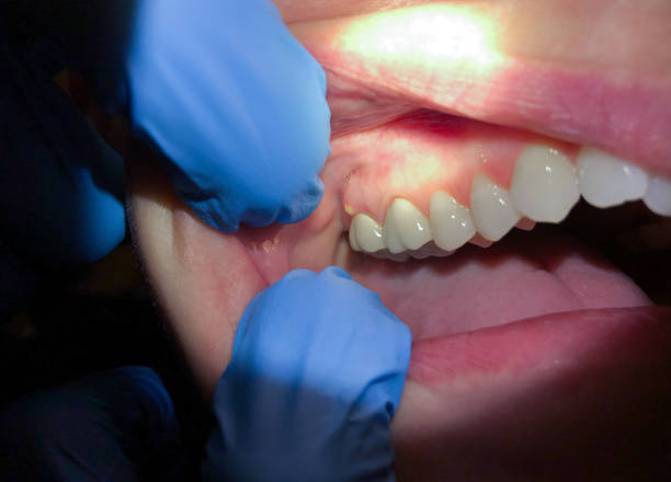 Best Emergency Dentist for Lost Fillings or Crowns in Port Aransas, TX